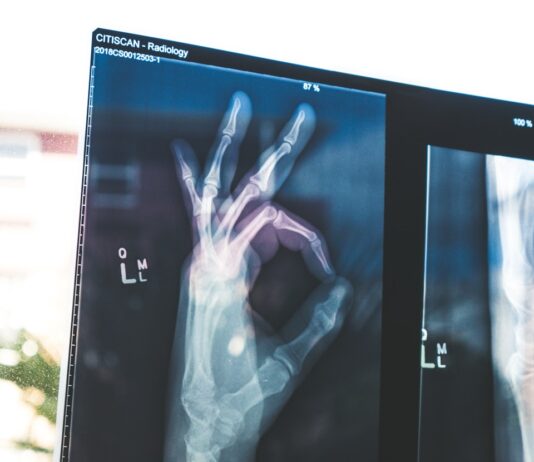 튼튼한 뼈, 건강한 삶…골다공증 예방과 뼈 건강 관리법 citiscan result hand ok